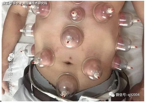 肚子拔罐视频,肚子上的秘密，轻松缓解多种不适