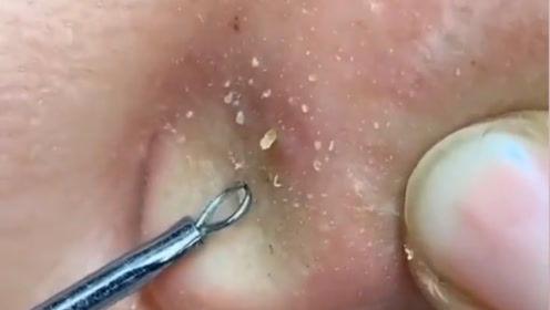 挑黑头视频,跟随挑黑头视频学技巧