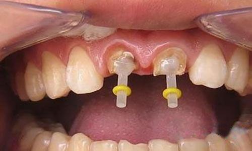 牙齿打桩视频,专业视角下的口腔修复之旅