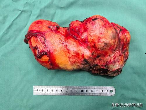 肿瘤切除视频,直观视频带你了解